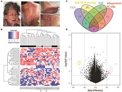 PSORS1C1 Hypomethylation Is Associated with Allopurinol-Induced Severe Cutaneous Adverse Reactions during Disease Onset Period: A Multicenter Retrospective Case-Control Clinical Study in Han Chinese